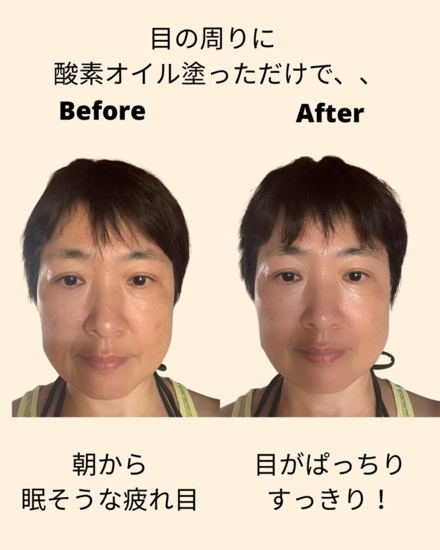 最近パソコン作業が多くて、目がお疲れ気味

この暑さで目の水分も不足してるのかも

ちょっと恥ずかしいけど、💦
自撮りでビフォーアフター
(すぐに削除するかもー)

当サロンで使用している
酸素入りアルガンオイルを

目の周りに塗って
軽くツボ押ししてみました。

だいぶ目がスッキリぱっちり！

目の辛さがなくなると
気分も明るくなりますね。

今年初めからこのオイル使うようになってから、
肌のくすみが気にならなくなって、

それまではファンデーションを
塗り重ねてたのが、

今では薄塗りまたは
すっぴんでも外に出られるように。

8月は目のまわりの「温ケア➕オイルアイケア」

8月限定クーポンの使用で
「とろんアイマッサージ(酸素オイル使用)」
プレゼント🎁

初めての方も、
お久しぶりの方も

たくさんの方にお会いできたら嬉しいです！❤️

#とろんアイケア準備中 
#目元ケア #酸素オイル 
#8月限定クーポン 
#今月の小さなサービス 
#目の癒し #ごほうびアイケア 
#マッサージセラピスト 
#フェイシャルオプション 
#手から癒しを